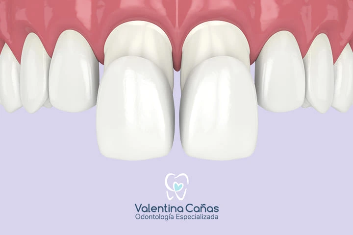 Carillas dentales estéticas para transformar tu sonrisa en Cali