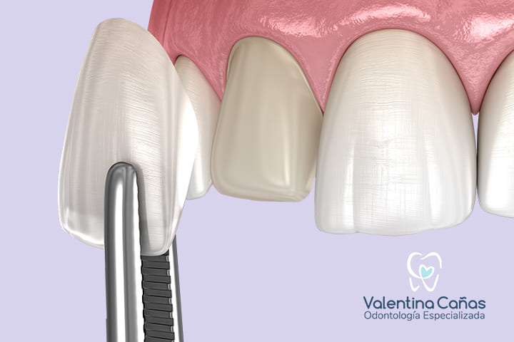 Diseño de Sonrisa - Transforma tu sonrisa con armonía y naturalidad Diseño de sonrisa con la Dra. Valentina Cañas en Cali - Estética dental personalizada