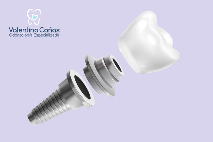 Implantes Dentales - Servicio especializado para reemplazo dental en Cali Servicio de implantes dentales en Cali con la Dra. Valentina Cañas, especialista en Implantología Oral